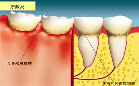 牙龈出血究竟怎么回事？原来是这3种病！(图2)