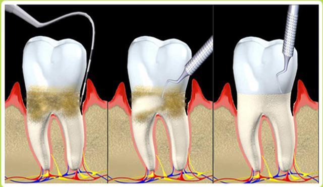 牙龈出血究竟怎么回事？原来是这3种病！(图4)